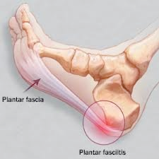 Traumeel injections for plantar fasciitis hotsell